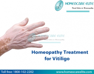 Homeopathy treatment for Vitiligo in Masab Tank